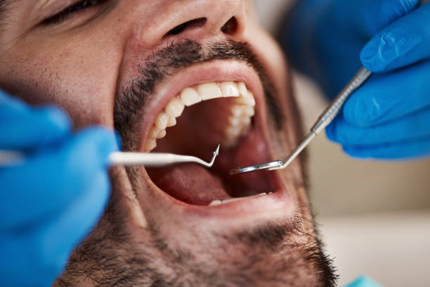 Best Emergency Tooth Extraction in Spencerville, OH