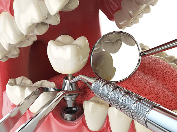 Best Emergency Dental Care for Broken or Chipped Teeth in Spencerville, OH